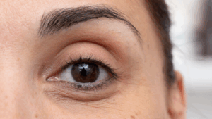 שקיות מתחת לעיניים טיפול טבעי