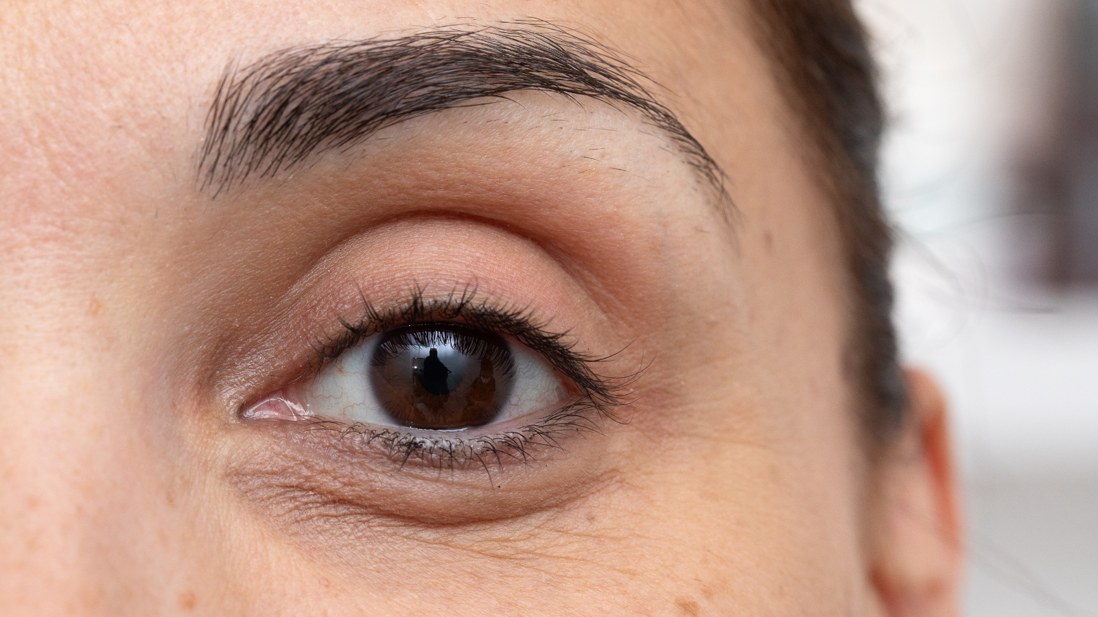 שקיות מתחת לעיניים טיפול טבעי